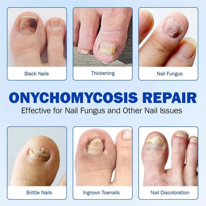 FUNGEX™ – Nagelpflaster gegen Nagelpilz